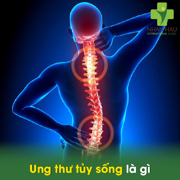 Ung thư tủy sống là gì