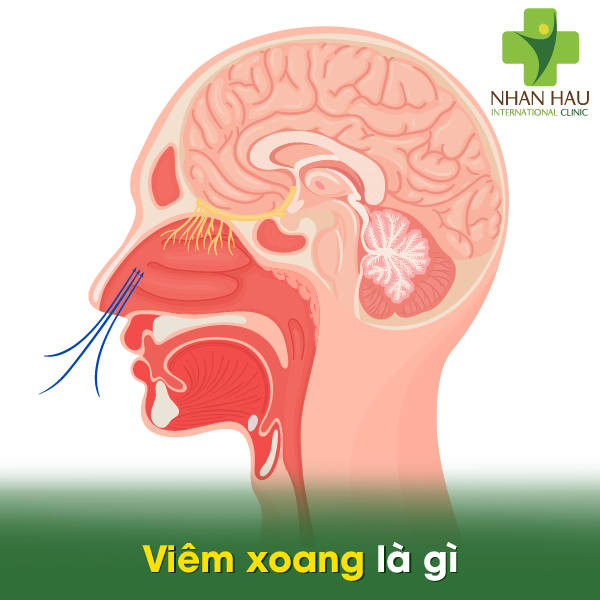 Viêm xoang là gì