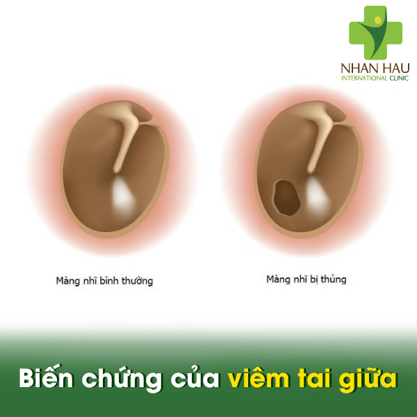Biến chứng của viêm tai giữa
