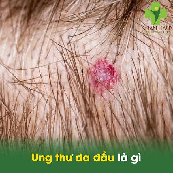 Ung thư da đầu là gì