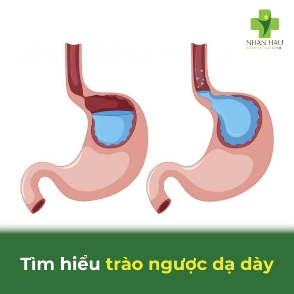 trào ngược dạ dày gerd là gì