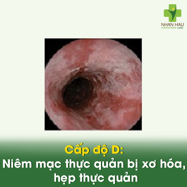 Cấp độ D: Niêm mạc thực quản bị xơ hóa, hẹp thực quản.