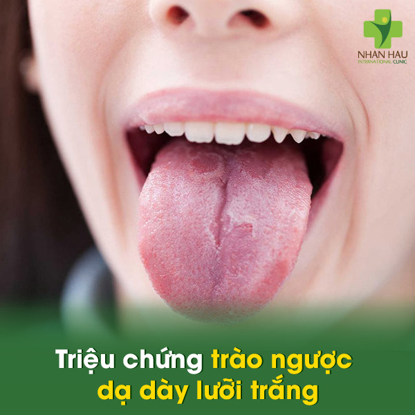 Triệu chứng trào ngược dạ dày lưỡi trắng