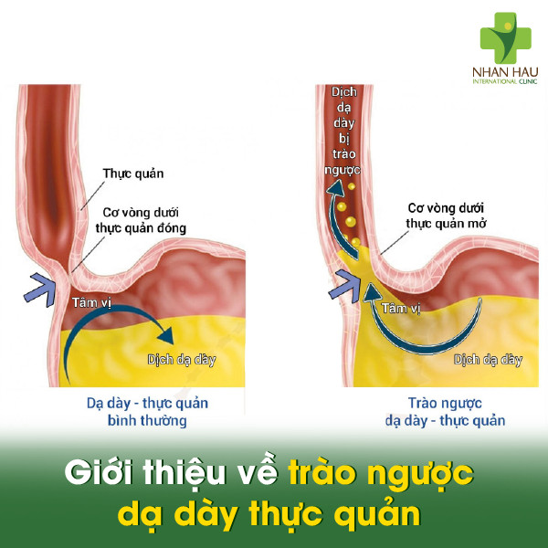 Giới thiệu về trào ngược dạ dày thực quản