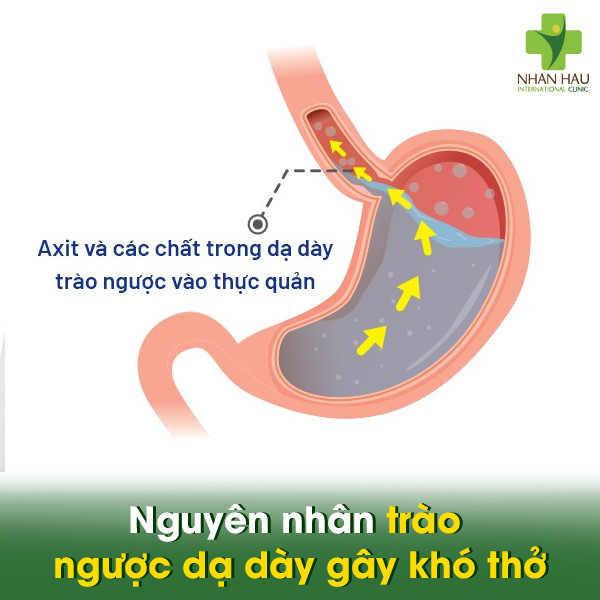 Nguyên nhân trào ngược dạ dày gây khó thở