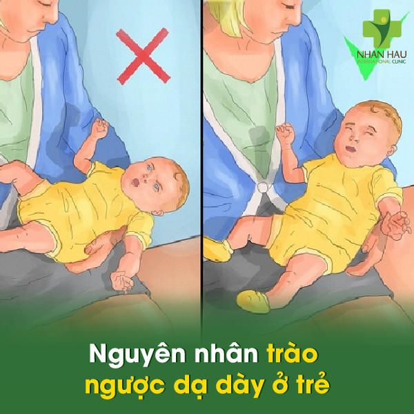 Nguyên nhân trào ngược dạ dày ở trẻ