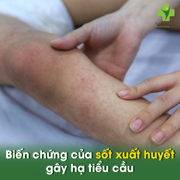 Biến chứng của sốt xuất huyết gây hạ tiểu cầu
