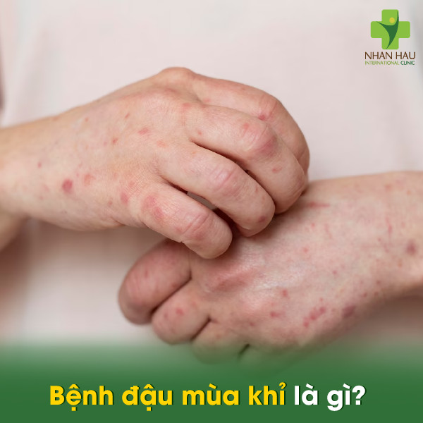 Bệnh đậu mùa khỉ là gì