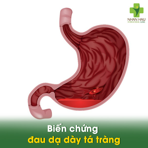 Biến chứng đau dạ dày tá tràng