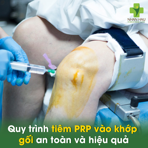 Quy trình tiêm PRP vào khớp gối an toàn và hiệu quả