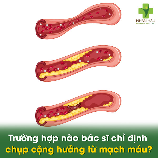 Trường hợp nào bác sĩ chỉ định chụp cộng hưởng từ mạch máu?
