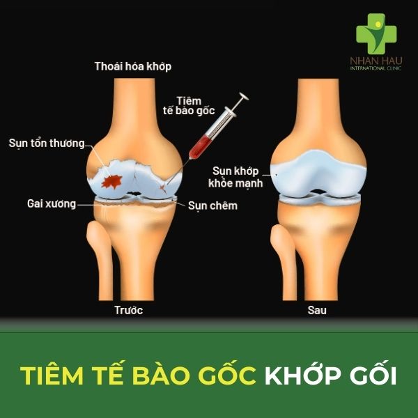 tiêm tế bào gốc khớp gối