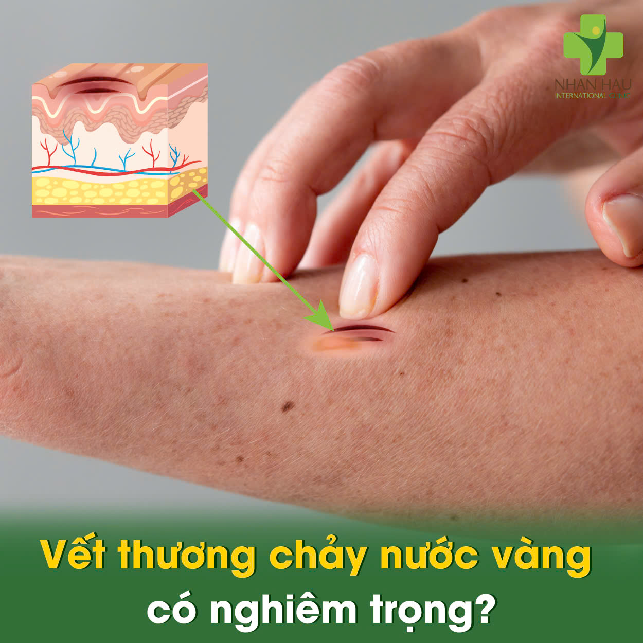 Vết thương chảy nước vàng có nghiêm trọng không?